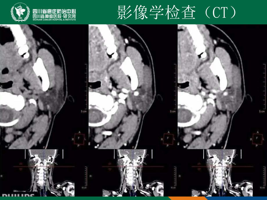 神经鞘瘤病例讨论一例课件.ppt_第3页