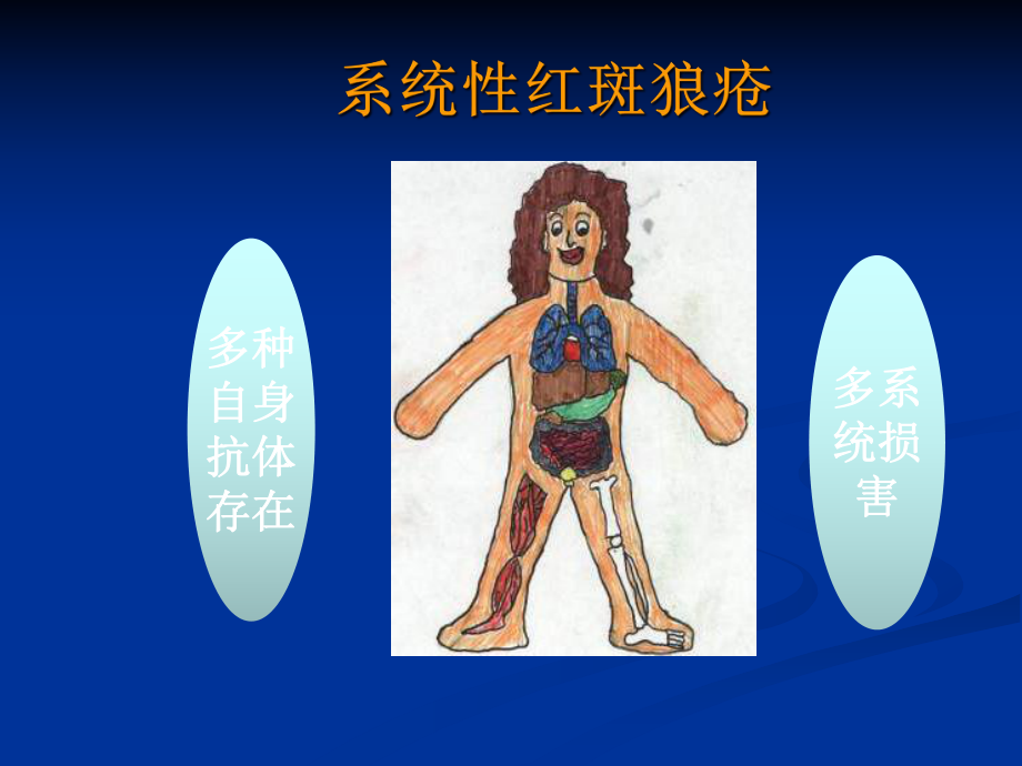 系统性红斑狼疮(临床专业)课件.ppt_第3页