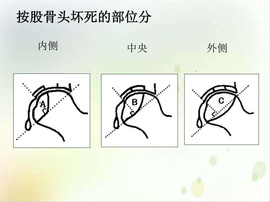 股骨头坏死ARCO分期围塌陷期讲课课件.ppt_第3页