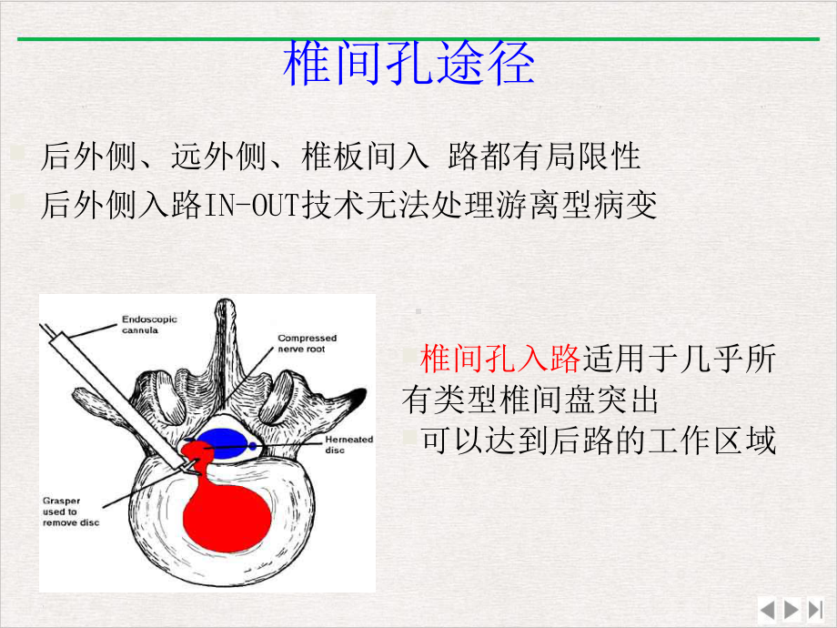 经皮介入椎间孔镜下椎间盘髓核切除术课件完整版.pptx_第3页