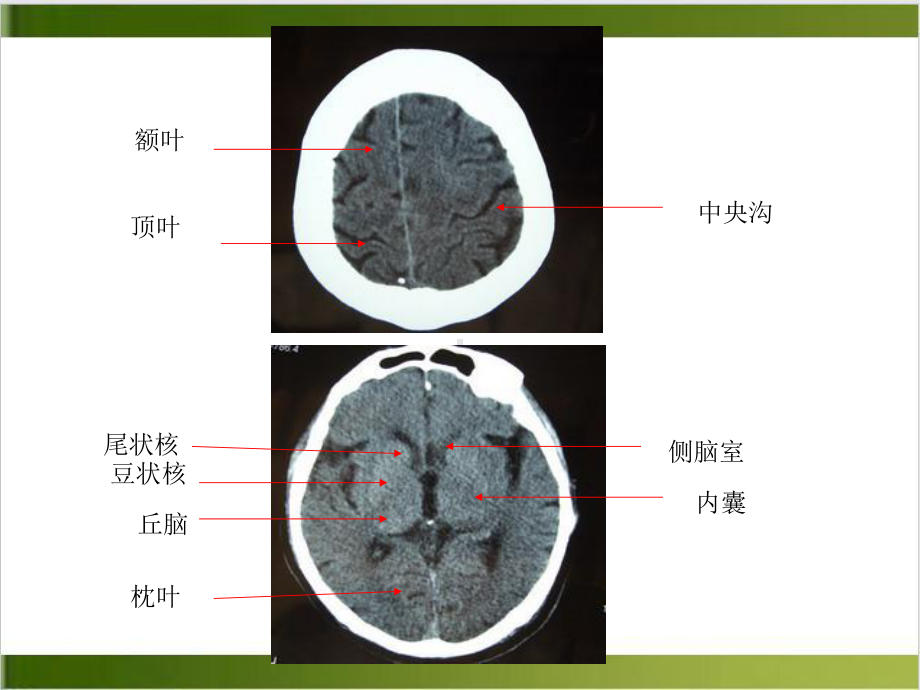 神经内科头部CTMRI的基本结构课件.pptx_第3页