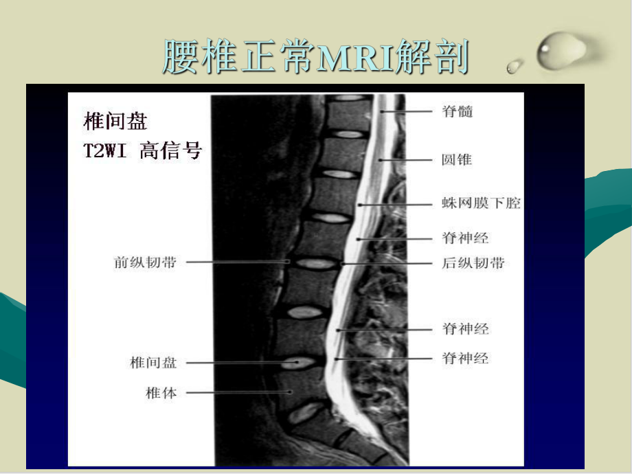 腰椎间盘病变的MRI诊断培训课件.ppt_第2页