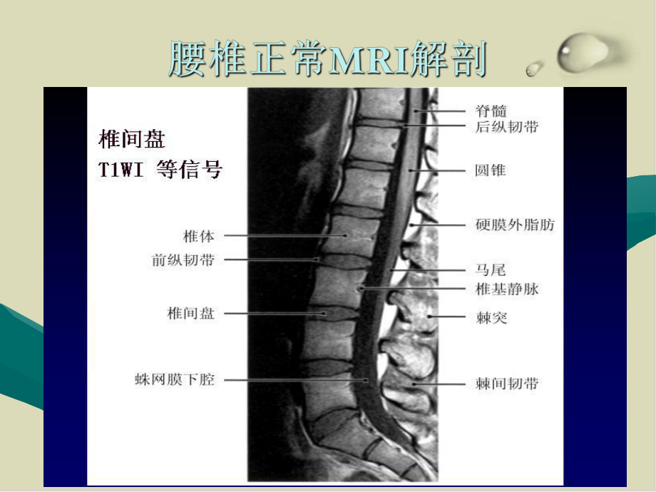 腰椎间盘病变的MRI诊断培训课件.ppt_第3页