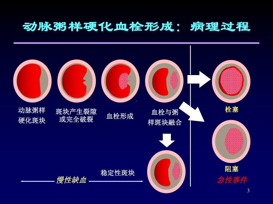 纳洛酮在急性重症脑梗死中的应用课件.ppt_第3页