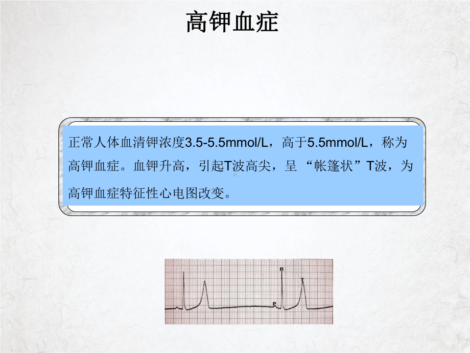 电解质紊乱心电图授课课件.ppt_第2页