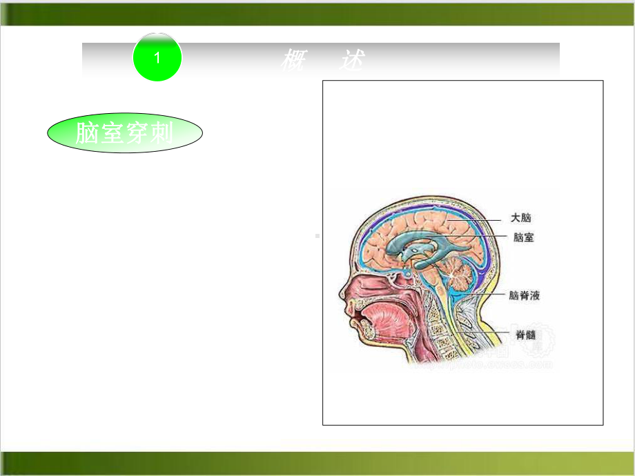 脑室引流的护理课件整理.ppt_第3页