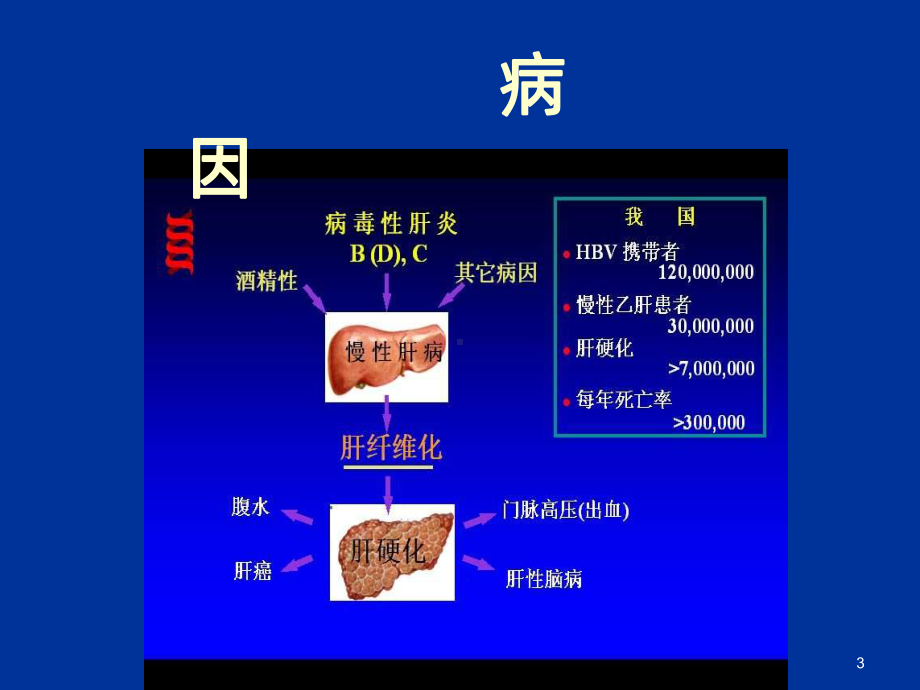 肝硬化教学讲诉课件.ppt_第3页