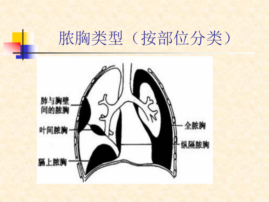 脓胸教课件.ppt_第2页