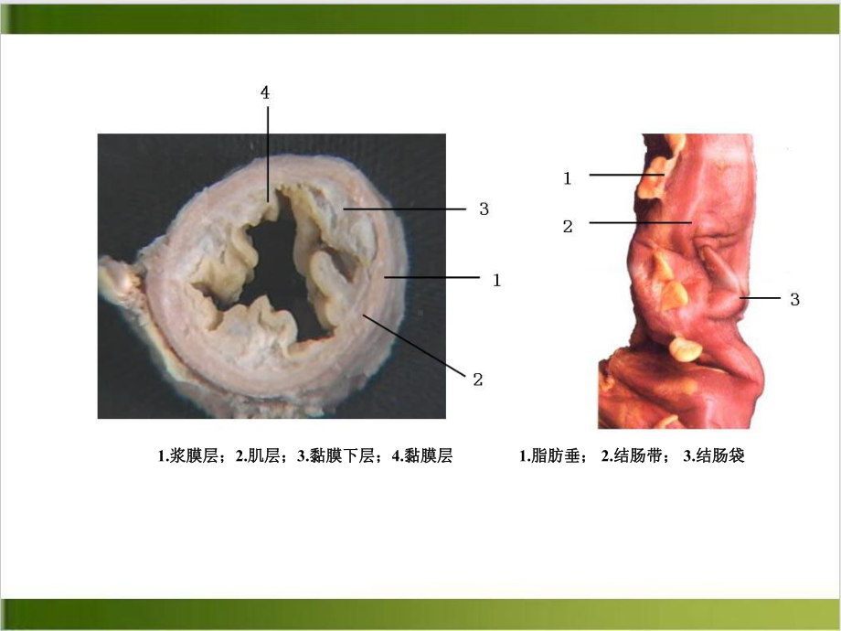 结肠直肠肛管疾病优秀案例课件.ppt_第3页