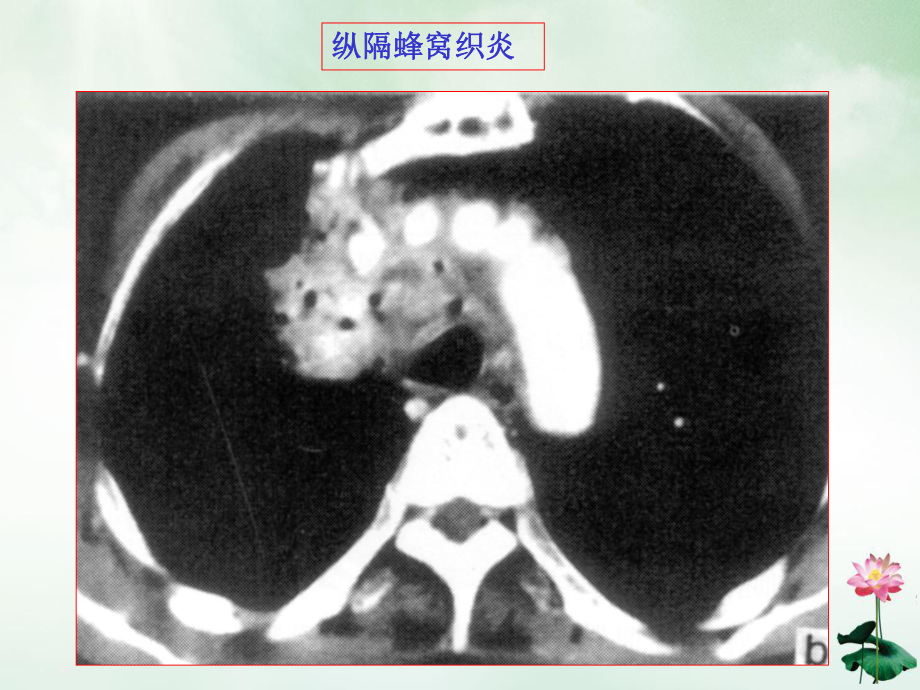 纵隔常见疾病的CT表现课件.pptx_第2页