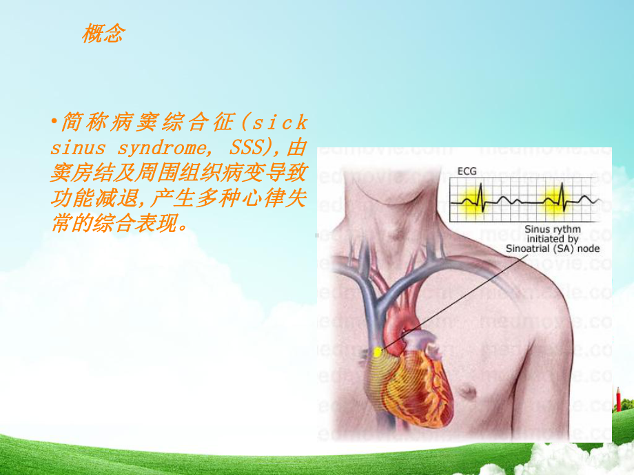 病态窦房结综合征课件整理.ppt_第2页