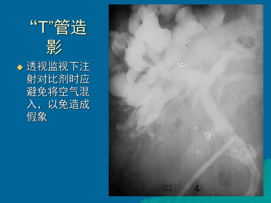 胆系影像诊断学课件.ppt_第3页