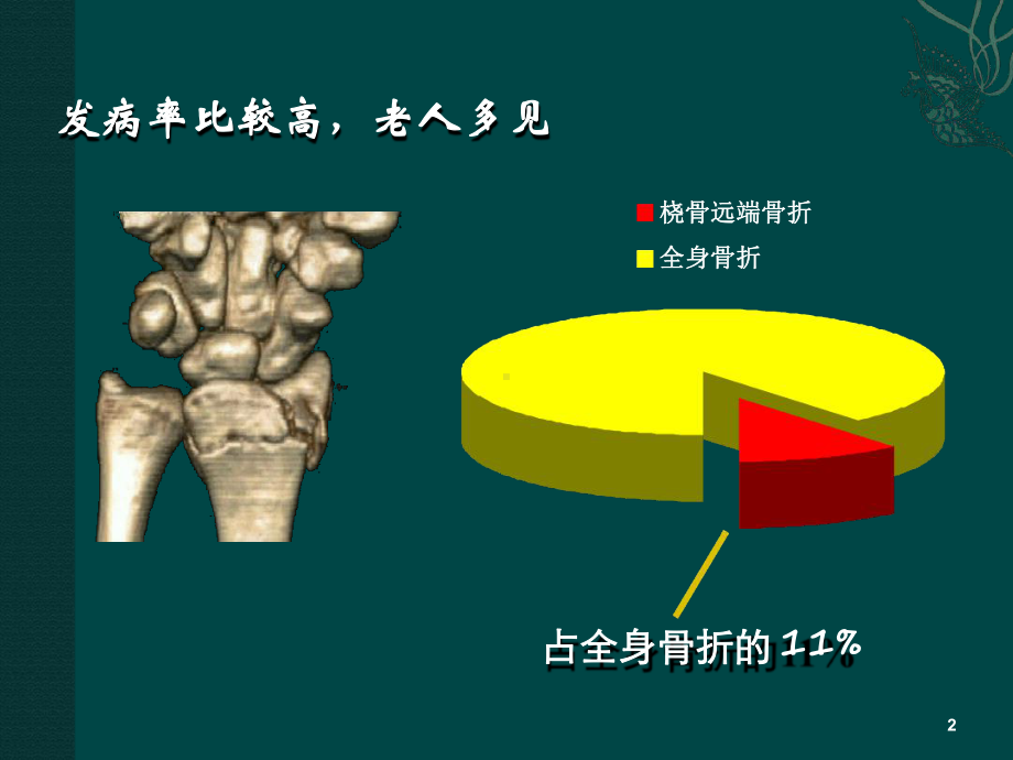 管理资料桡骨远端骨折课件汇编.ppt_第2页