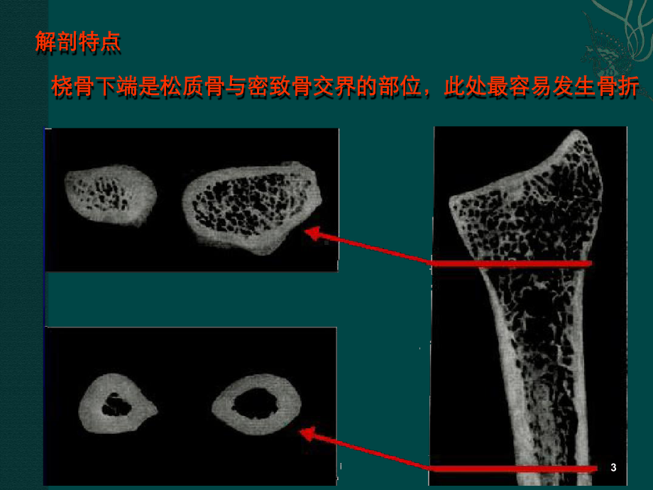 管理资料桡骨远端骨折课件汇编.ppt_第3页