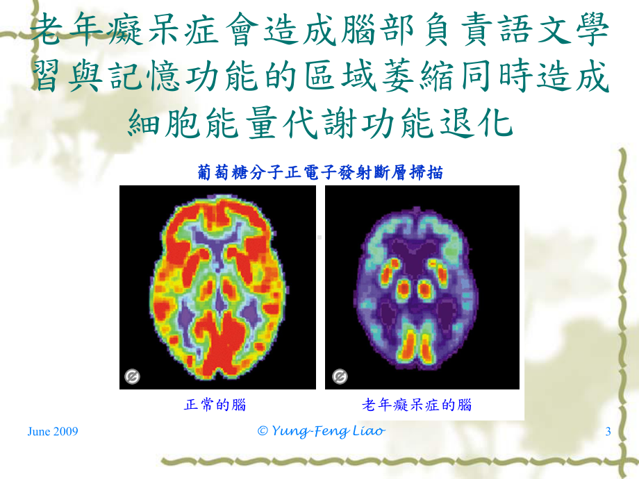 老年痴呆症及失智症课件.ppt_第3页