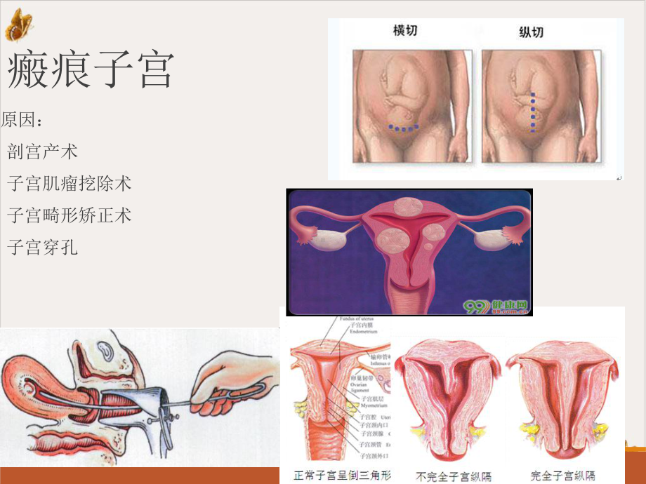 瘢痕子宫与产后出血实用课件.pptx_第2页