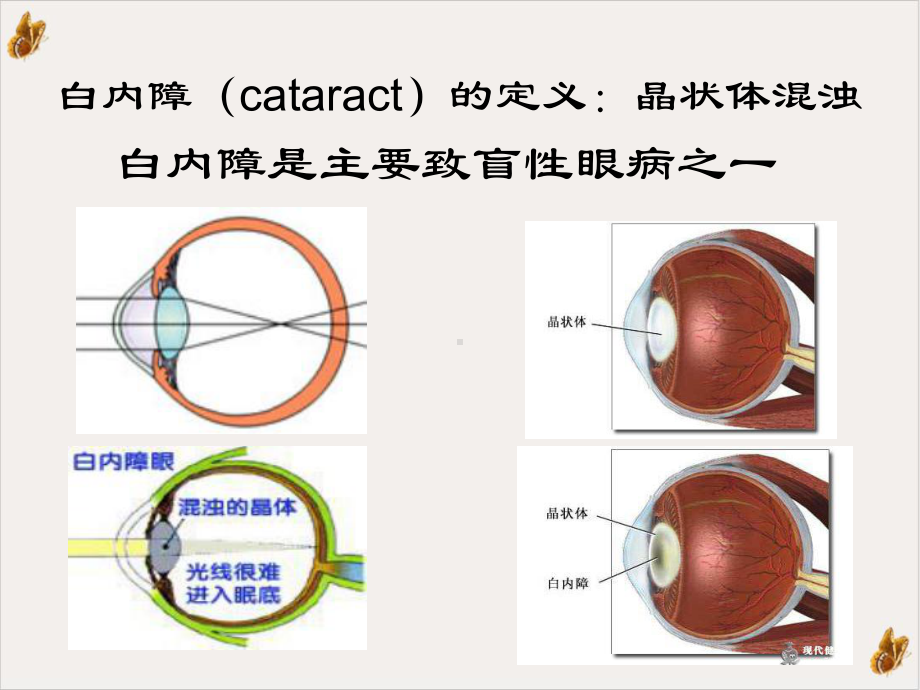 白内障和青光眼病人的护理课件.pptx_第1页