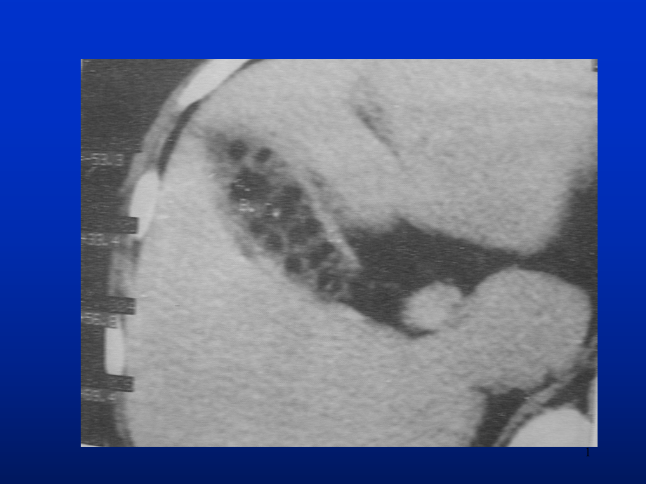 肝脏胆囊胰腺CT扫描技术课件.ppt_第1页