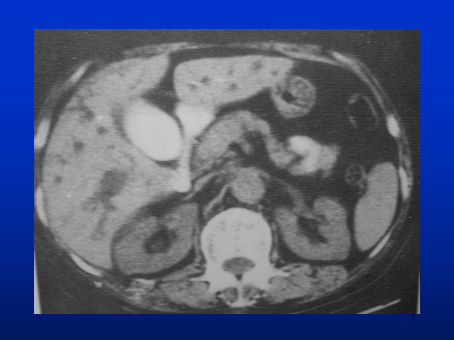 肝脏胆囊胰腺CT扫描技术课件.ppt_第2页