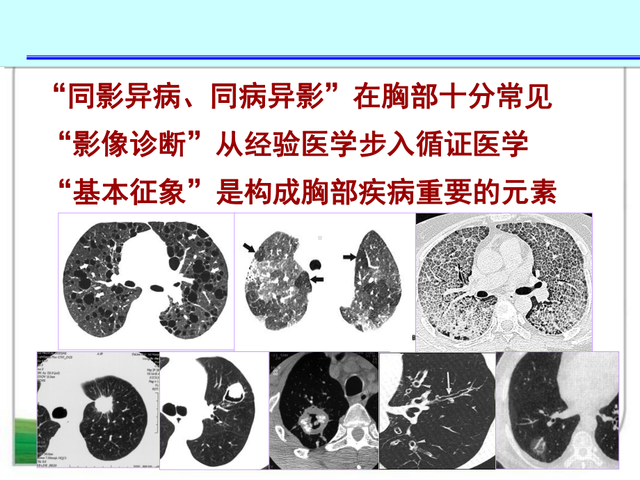 肺部征象诊断应用课件.ppt_第2页