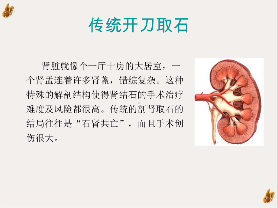 简析泌尿系结石微创治疗课件.pptx_第2页