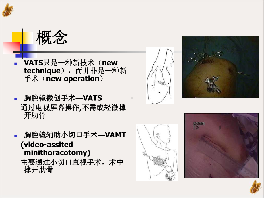 电视胸腔镜手术在胸心外科疾病诊治中的应用进展课件.pptx_第2页