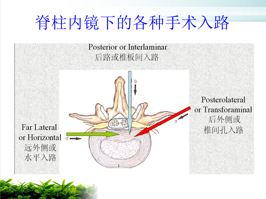 经皮介入椎间孔镜下椎间盘髓核切除术课件.pptx_第2页