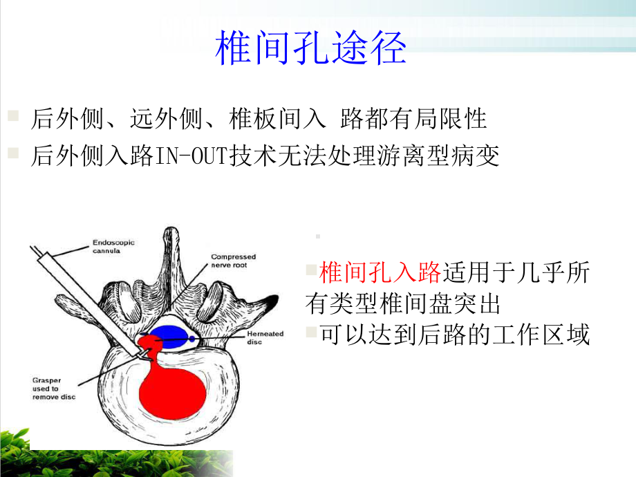 经皮介入椎间孔镜下椎间盘髓核切除术课件.pptx_第3页