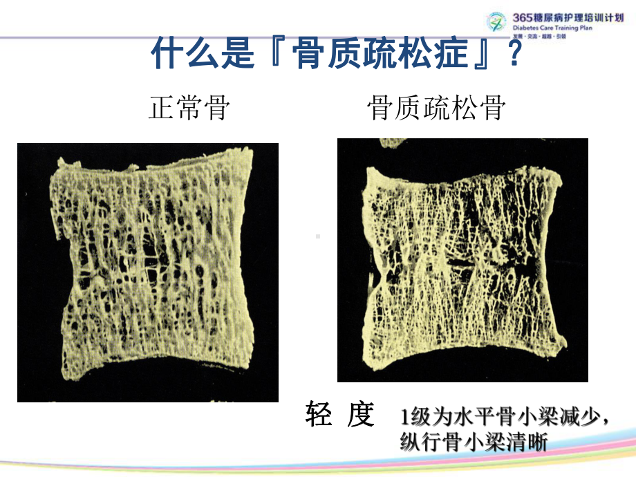 糖尿病性骨质疏松症课件.ppt_第2页