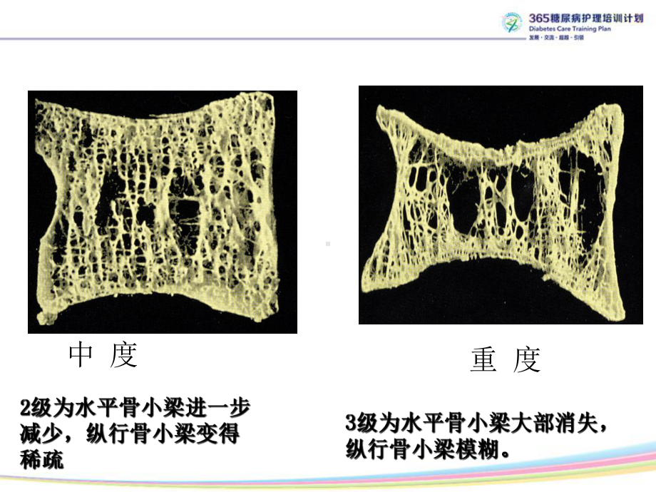 糖尿病性骨质疏松症课件.ppt_第3页