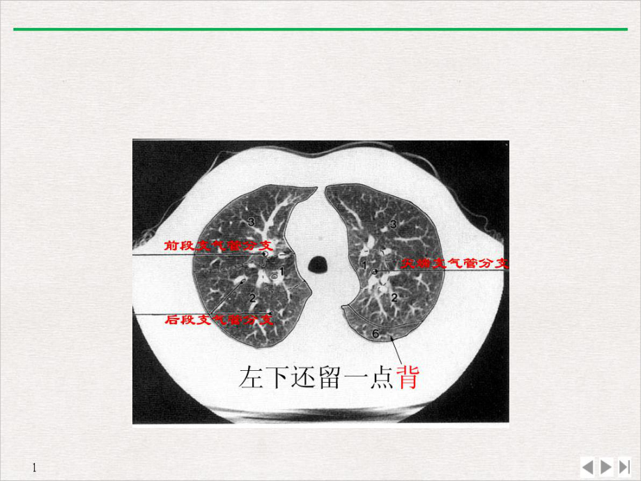 肺部CT分段课件.pptx_第2页