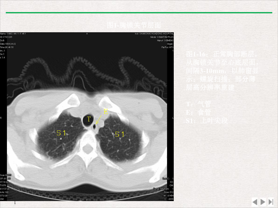 肺部CT分段课件.pptx_第3页