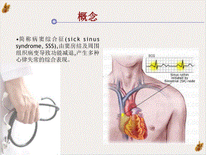 病态窦房结综合征课件.pptx