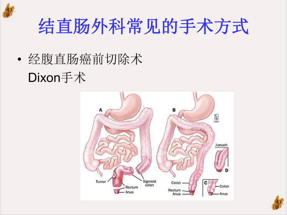 结肠造口与其护理课件1.pptx_第2页