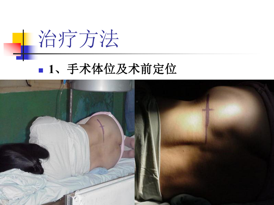 胶原酶髓核溶解术治疗腰椎间盘突出症课件.ppt_第3页