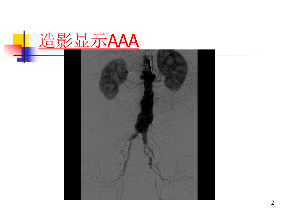 腹主动脉瘤腔内修复致右肾动脉阻塞后的处理过程课件.ppt_第2页