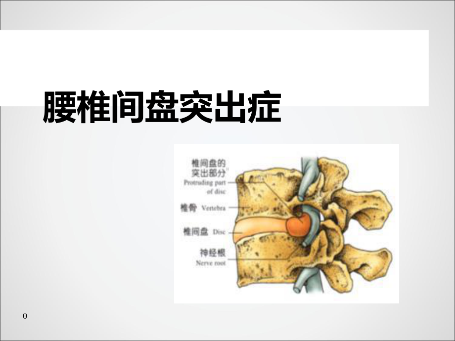 腰椎间盘突出症病人的护理-课件.ppt_第1页