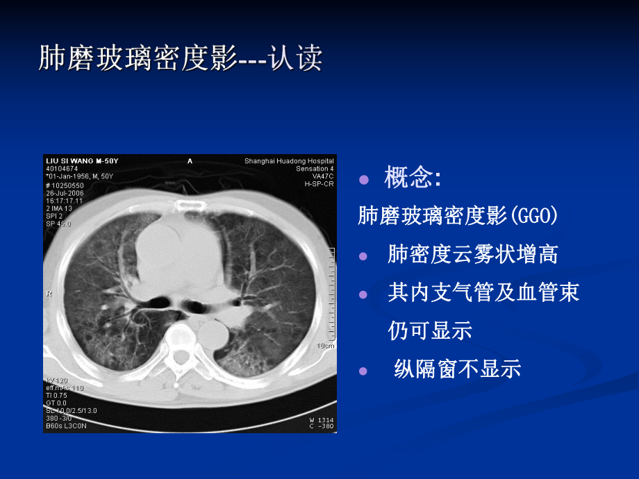 肺弥漫性磨玻璃密度影课件.ppt_第2页