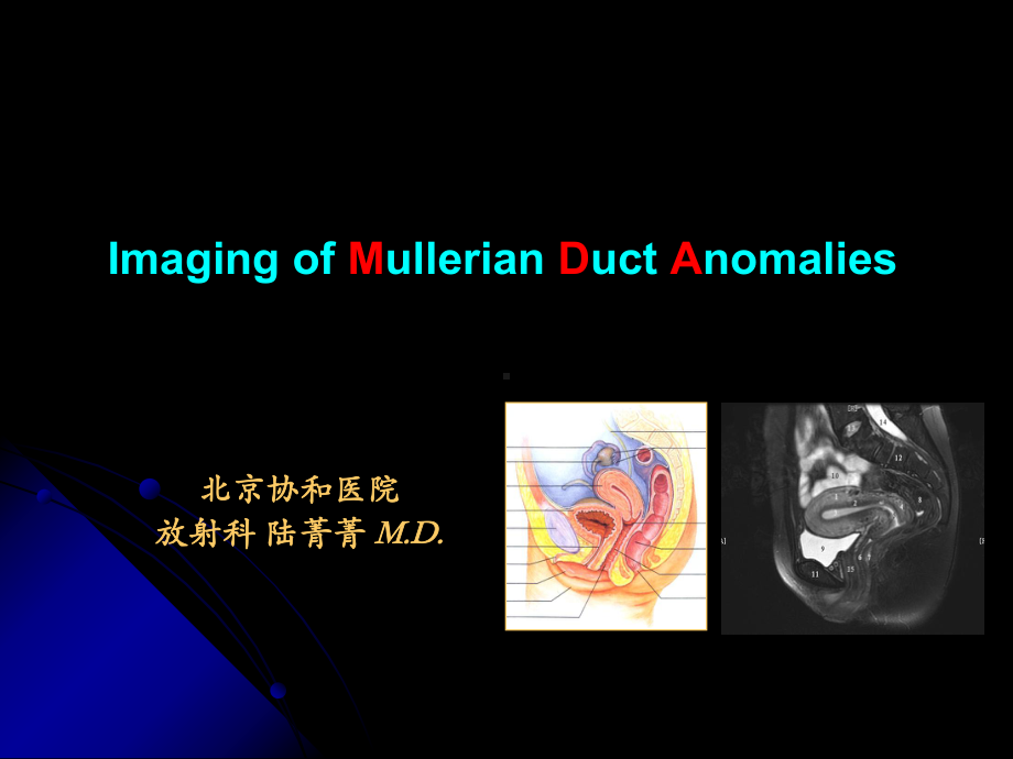 苗勒氏管畸形的影像学诊断北京协和医院课件.pptx_第1页