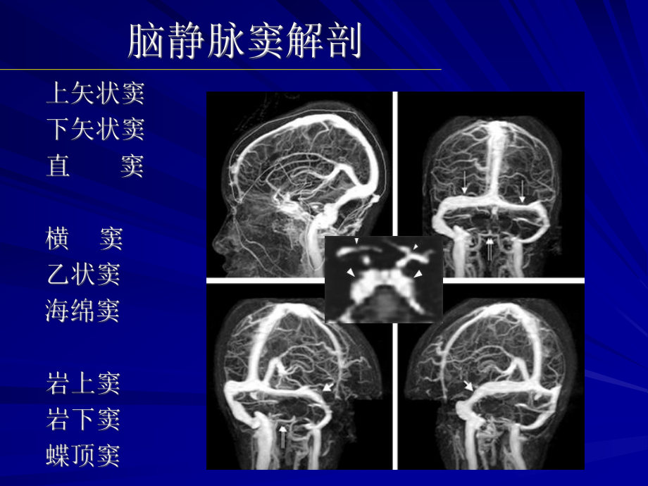 脑静脉和静脉窦血栓形成的影像学诊断(同名200)课件.ppt_第2页