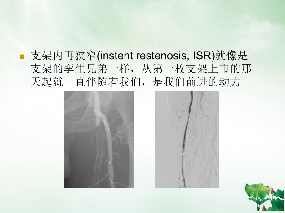 股动脉支架内再狭窄的介入处理授课课件.ppt_第3页