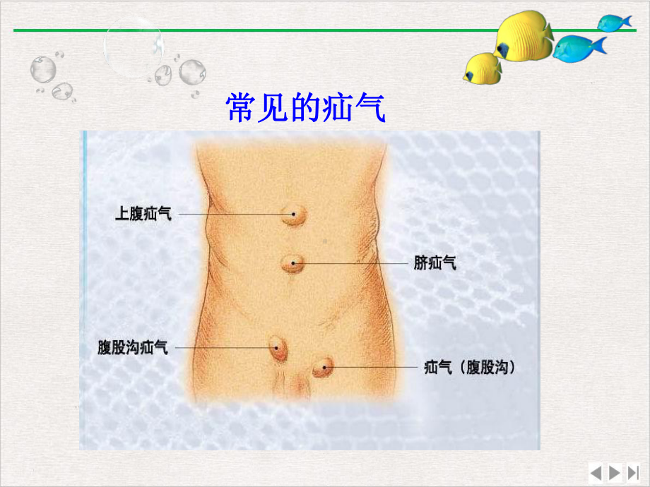 疝气手术配合课件.pptx_第3页