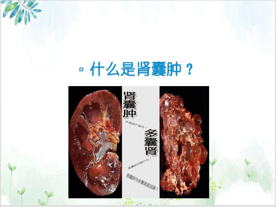 腹腔镜下肾囊肿切除术案例课件.ppt_第2页