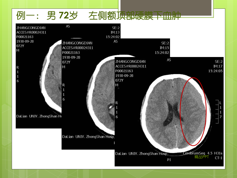 等密度硬膜下血肿的CT征象课件.ppt_第3页