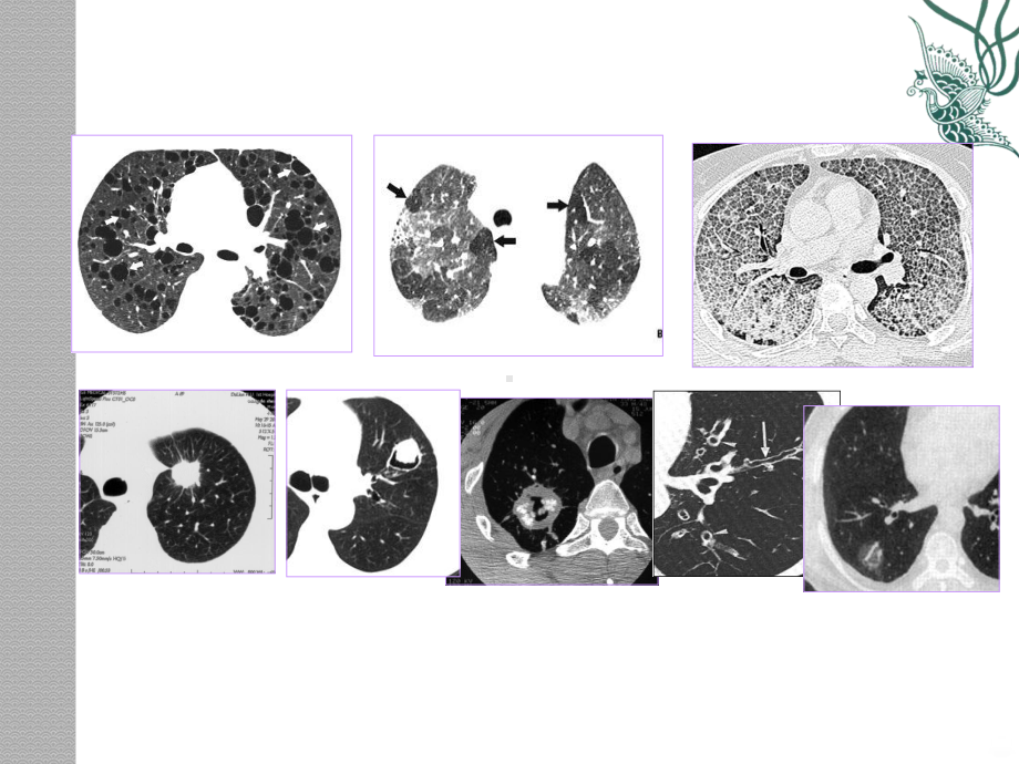 肺疾病的CT征象分析象课件.ppt_第2页