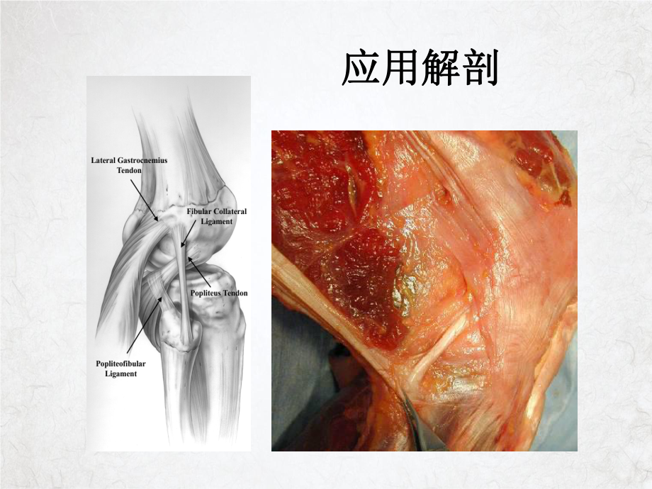 膝关节后外侧韧带结构损伤课件整理.ppt_第3页