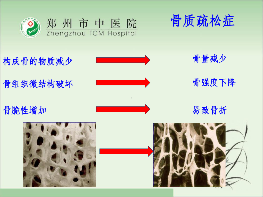 老年胸腰椎压缩性骨折的疼痛治疗策略课件.ppt_第3页