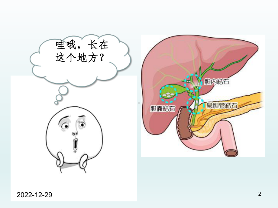 胆囊结石科普-课件.ppt_第2页