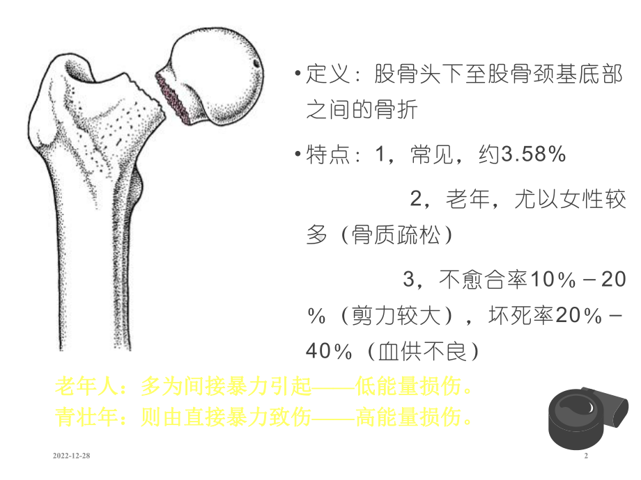 股骨颈骨折-课件.ppt_第2页