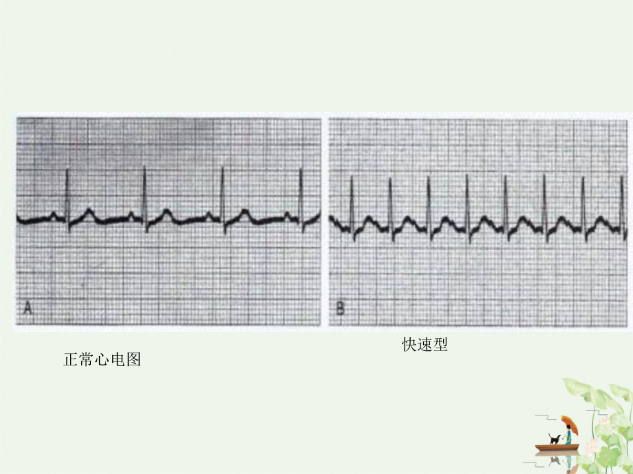 第三节抗心律失常药优质(同名75)课件.ppt_第3页